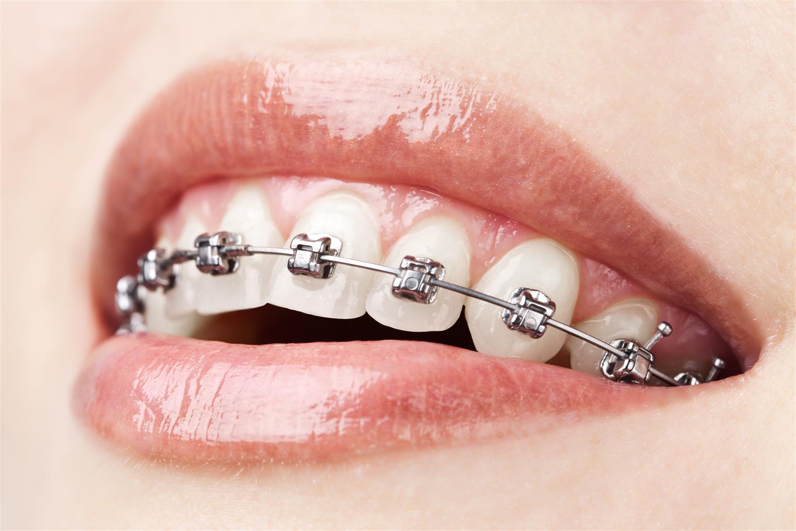 Cabinet-dentaire-Dr. Jihane OUEDGHIRI-orthodontie